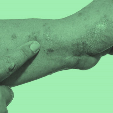 כשהגוף הופך את עורו