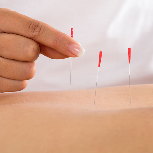 Dry Needling with Kent Ingvalson, PT, DPT, OCS