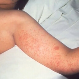 Quebec is at the epicentre of a measles outbreak in Canada. Here's what you need to know