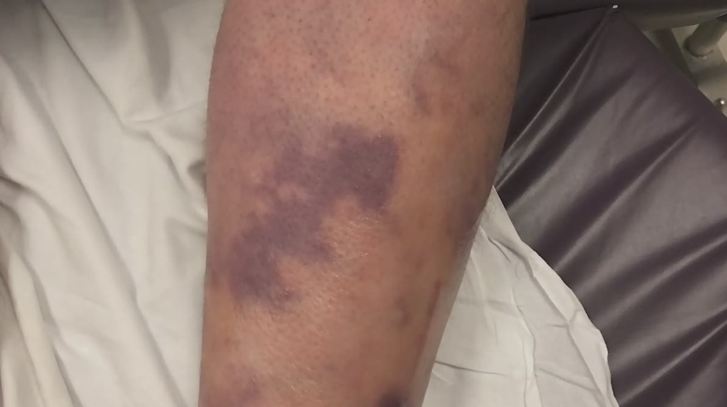 What is flesh-eating disease?