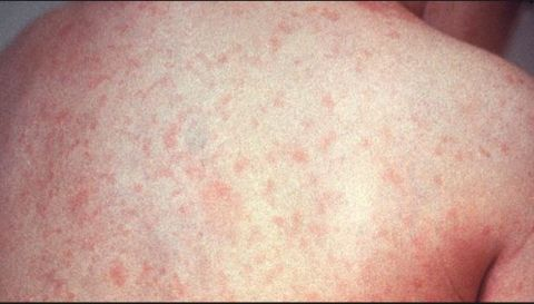 CFRA Live - Measles outbreak in Ontario traced back to a New Brunswick gathering