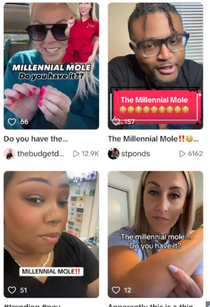 Do you have the mysterious ‘Millennial Mole’ everyone’s talking about?