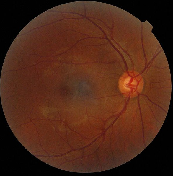 Kiwis 40+ urged to get their eyes tested this Glaucoma Awareness Month