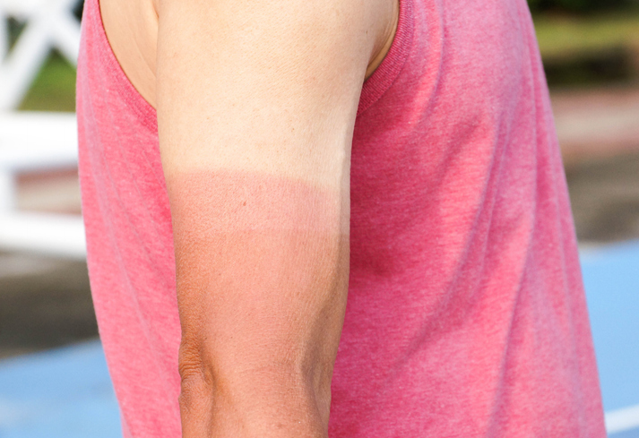 Mark Freie was reminded that sunscreen is helpful on a hot, sunny day