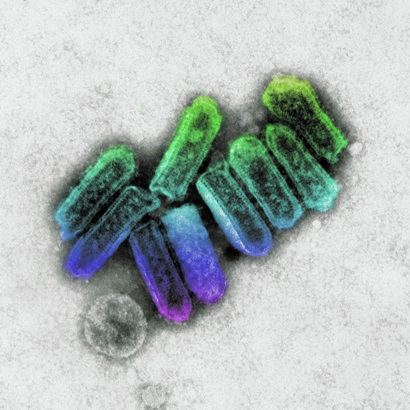 A Northern NSW man is in a critical condition with the state's first case of lyssavirus