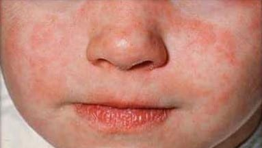 Measles warning for GC over Easter