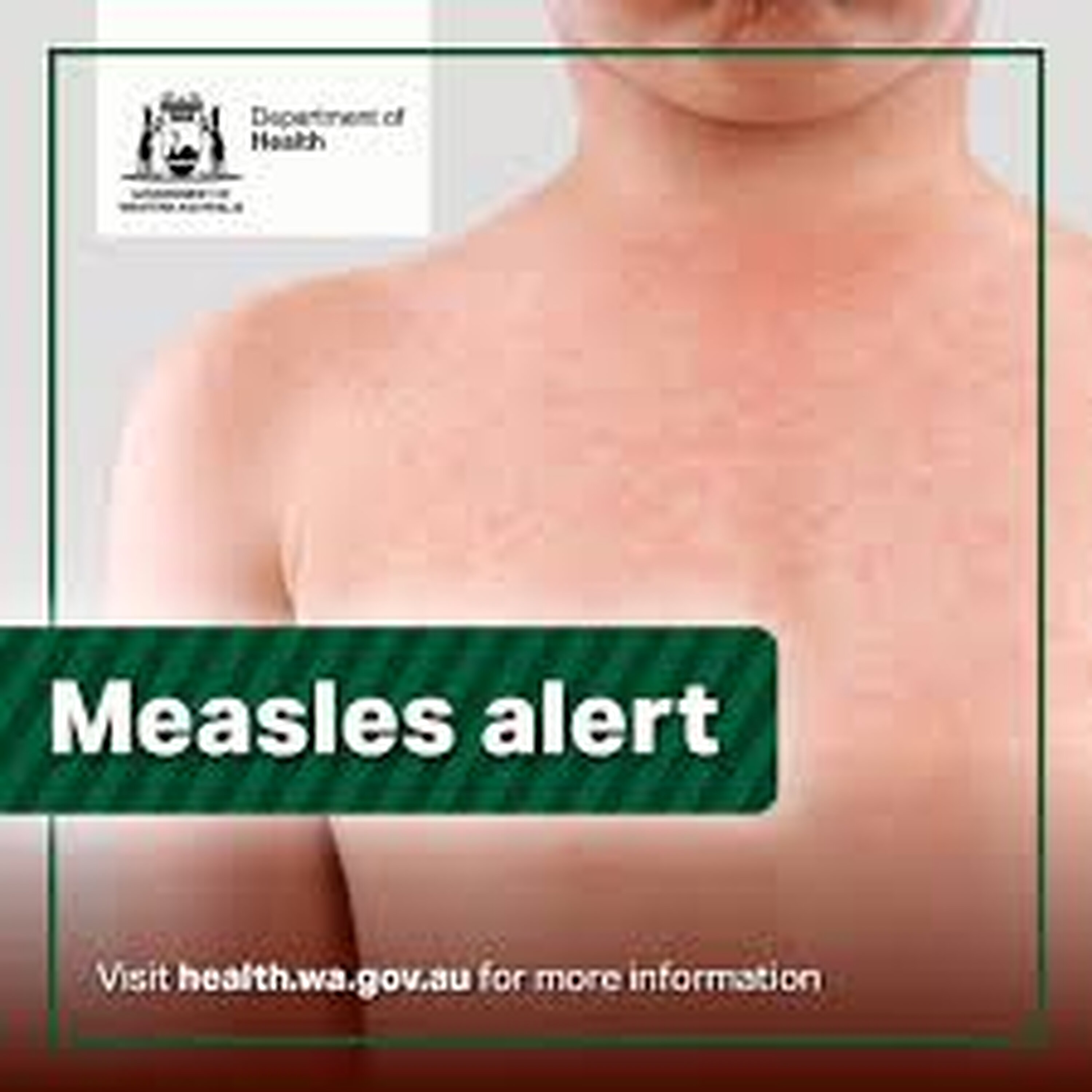 Measles exposure sites popping up across Great Southern and South-West