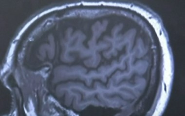 Testing for early detection of Alzheimer's trialed in Australia episode artwork