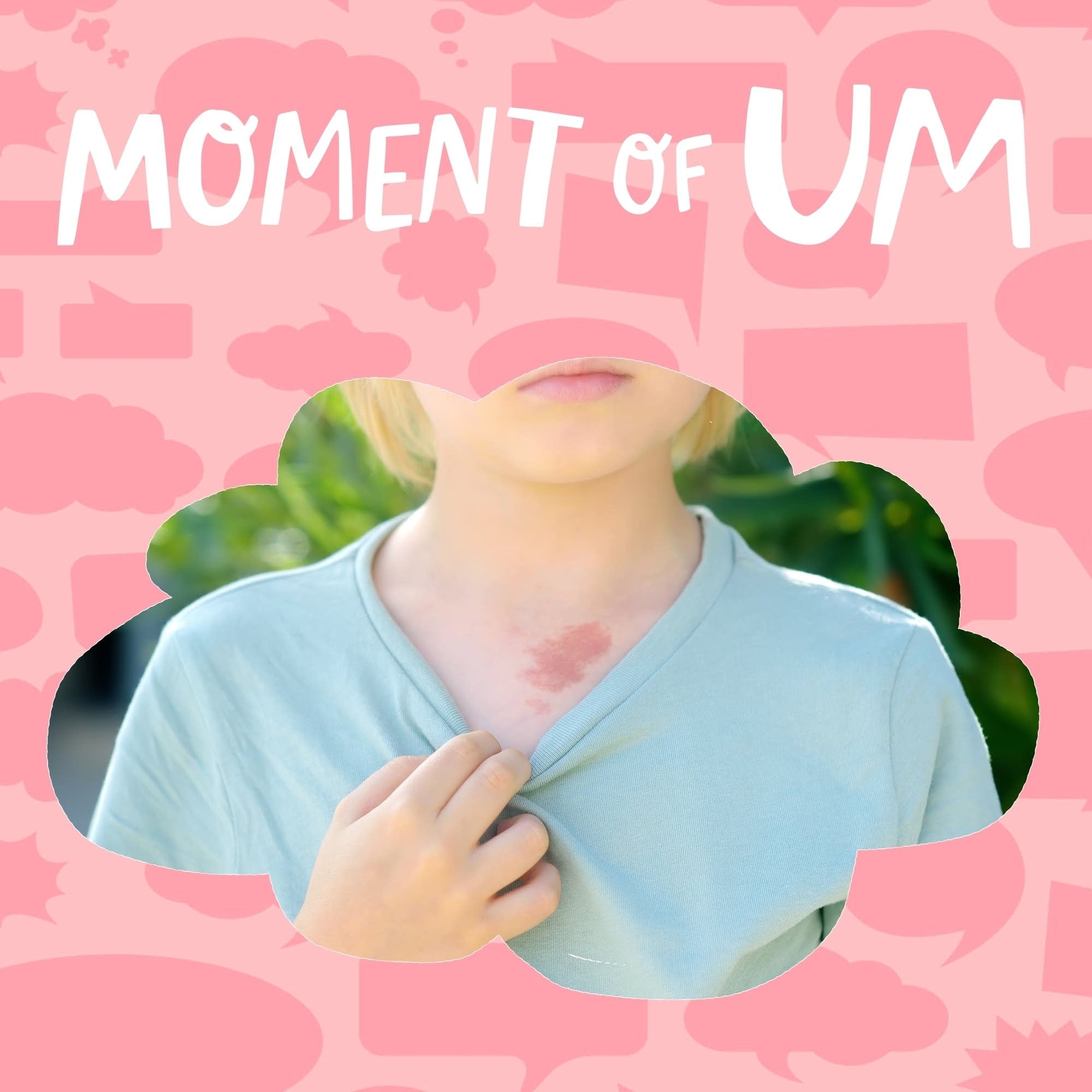 What are birthmarks?