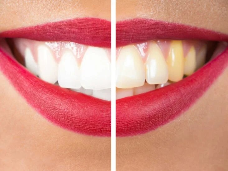 TRY THE TREND: TEETH WHITENING episode artwork