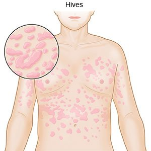 #PODCAST World Urticaria Day kicks-off a month long campaign aimed at raising vital awareness #sabcnews episode artwork
