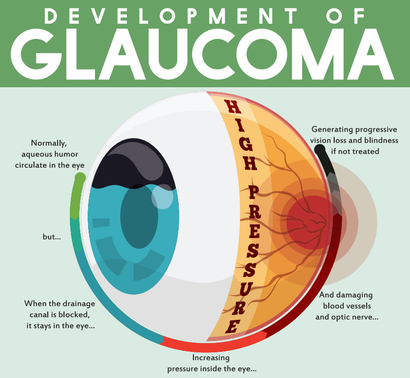 #PODCAST Ophthalmologists call for a greater rollout of screenings - as today marks World Glaucoma Day #sabcnews episode artwork