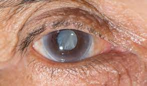 #PODCAST #WorldGlaucomaWeek Health expert sheds light on vision impairment episode artwork