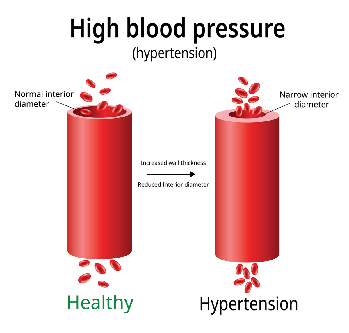 #PODCAST Young South Africans advised to get their blood pressure tested to avoid being another statistic of hypertension #sabcnews