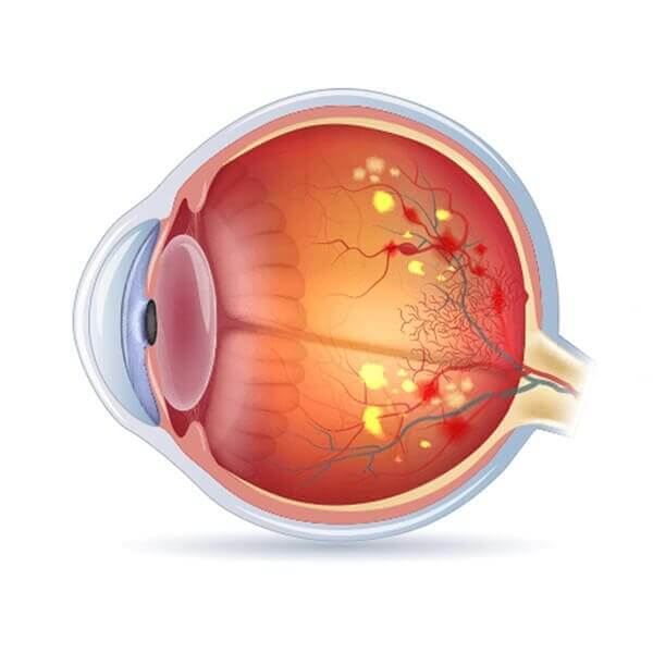 #PODCAST Ophthalmological Society of South Africa discuss the seriousness of the diabetic retinopathy eye condition #sabcnews episode artwork