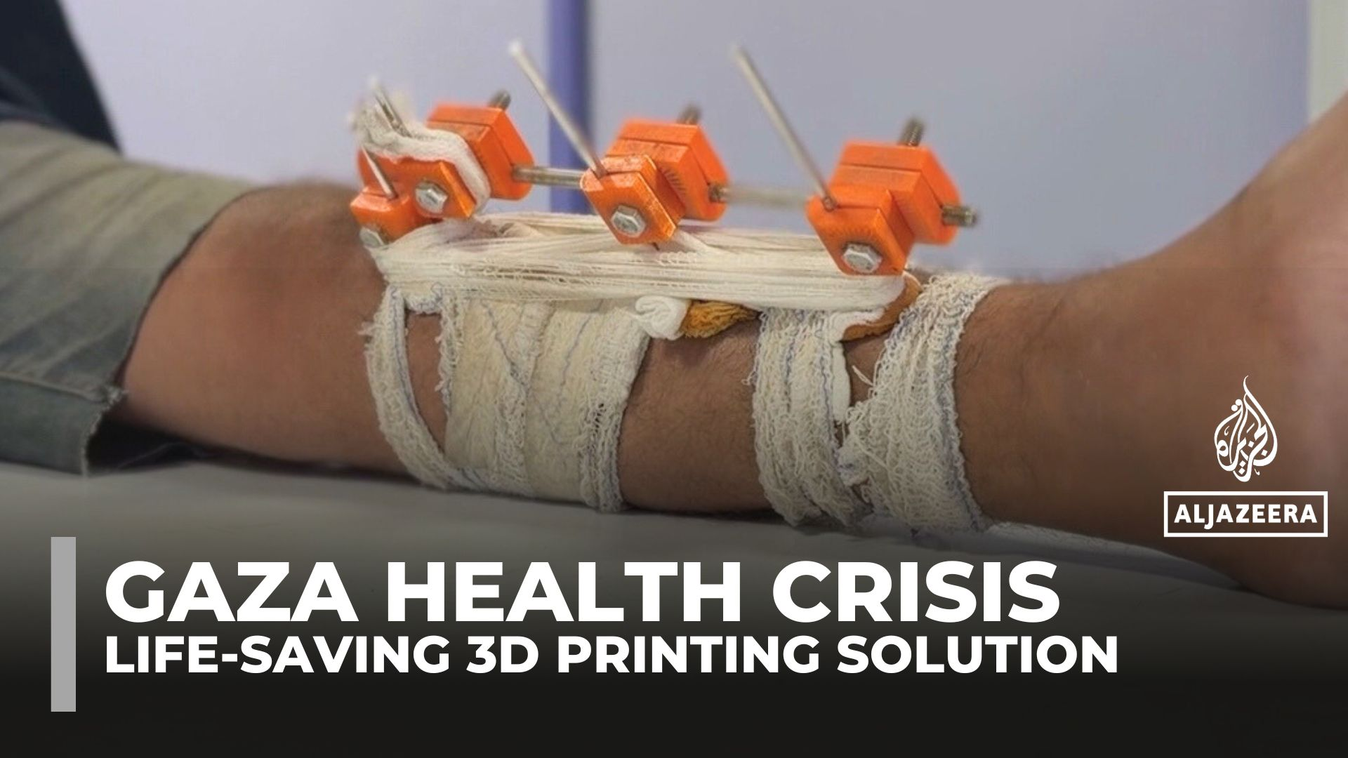 Gaza doctors use solar‑powered 3D printing to save limbs and lives