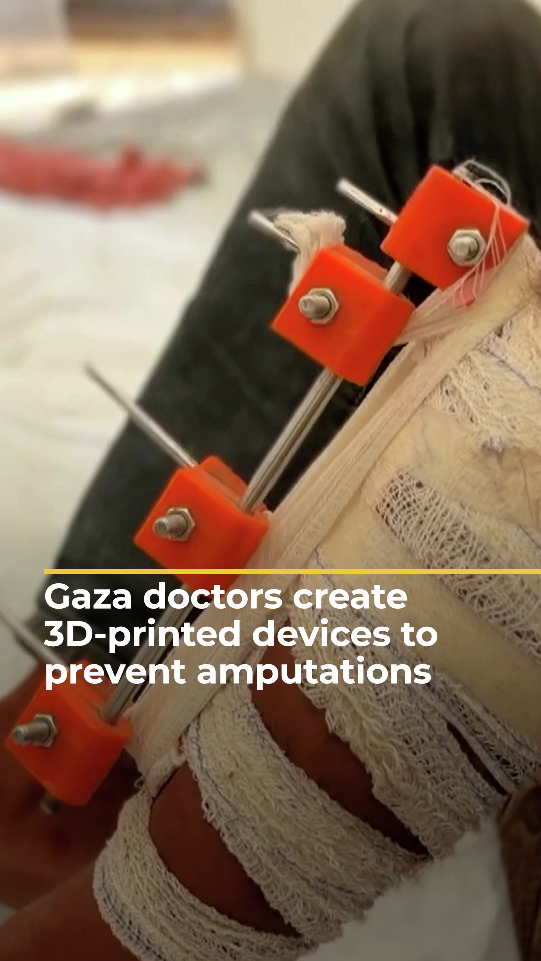 Gaza doctors create 3D-printed devices to save patients from amputation