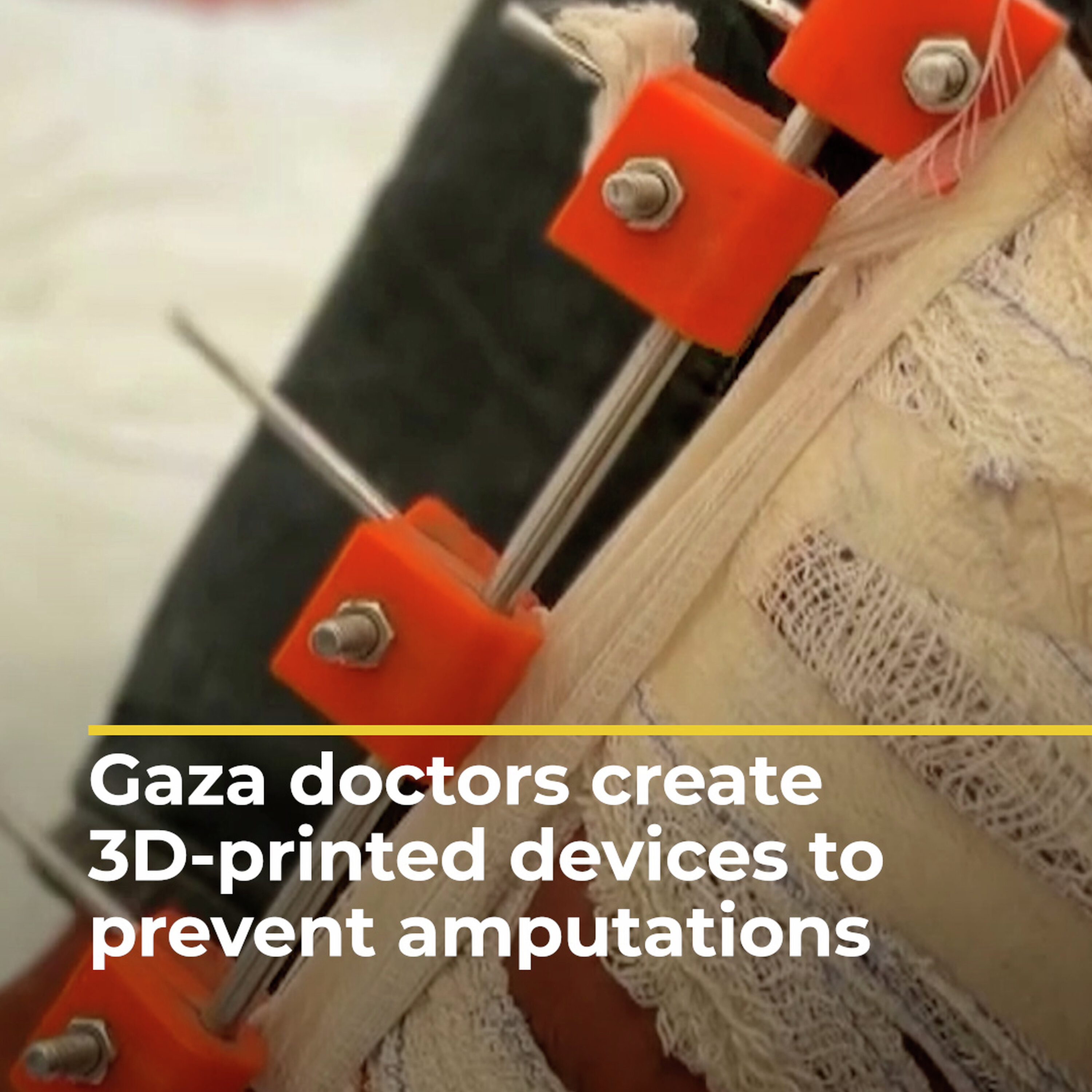 Gaza doctors create 3D-printed devices to save patients from amputation Gaza doctors create 3D-printed devices to save patients from amputation