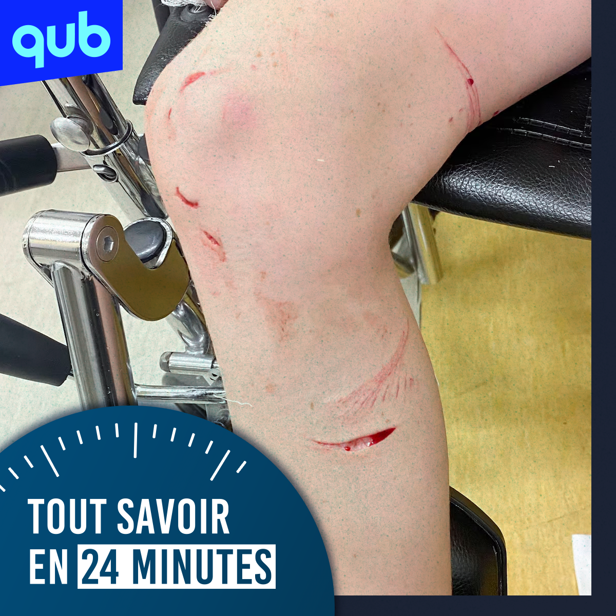 Un enfant mordu par un poisson mystérieux… et la blessure est assez grosse merci!