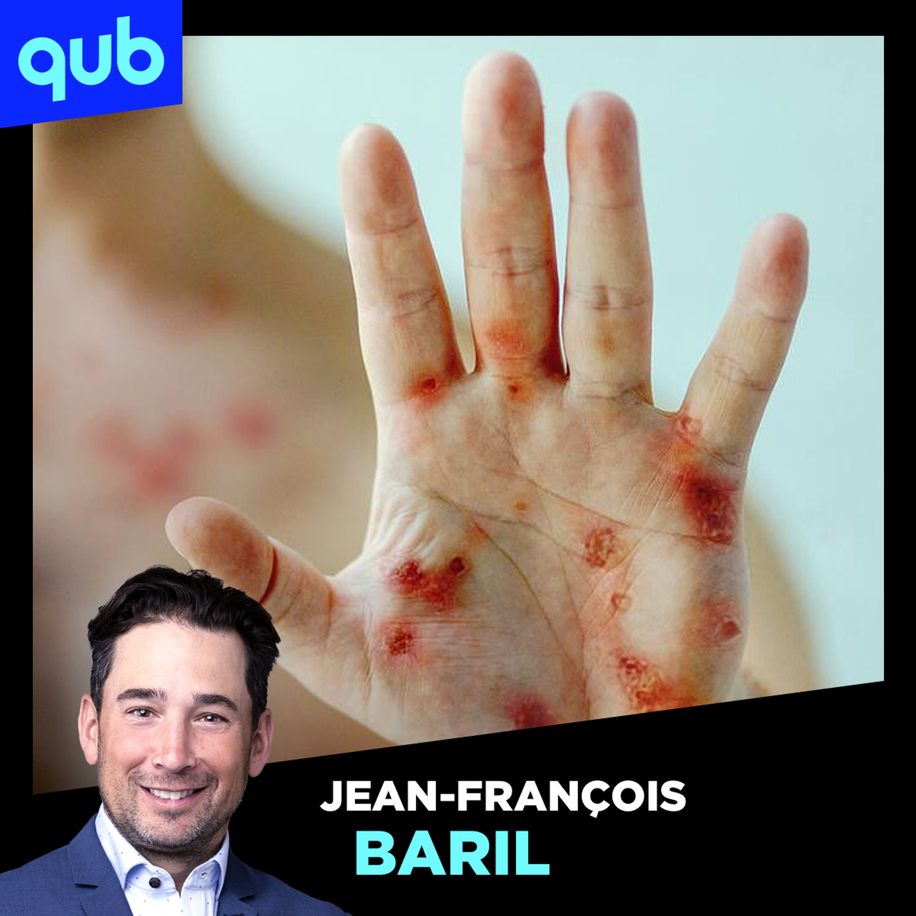 MPOX : «C’est un virus pour lequel on a un vaccin», rassure Réjean Thomas, médecin