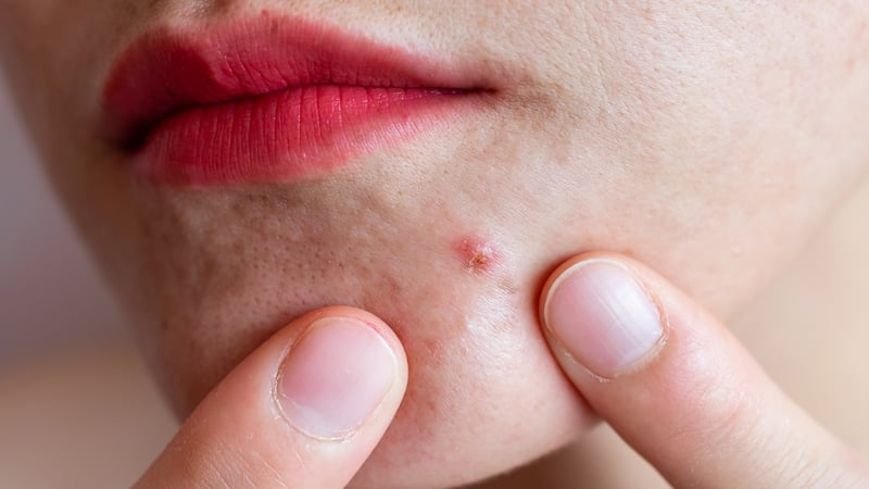 "Acne affects 35% of women and 20% of men"