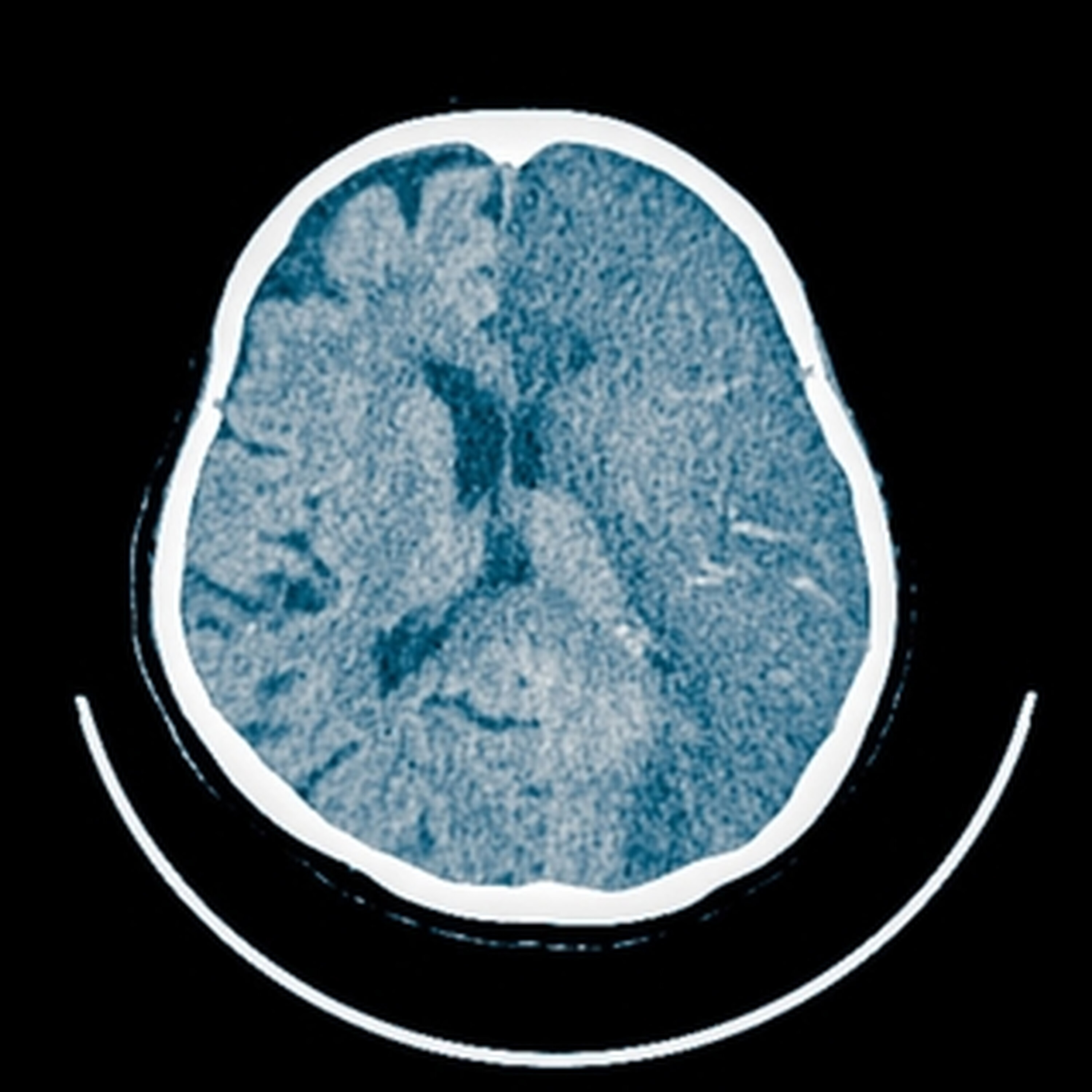 Stroke survivor speaks about his harrowing experience and recovery