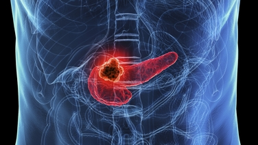 Breakthrough in the treatment of pancreatic cancer