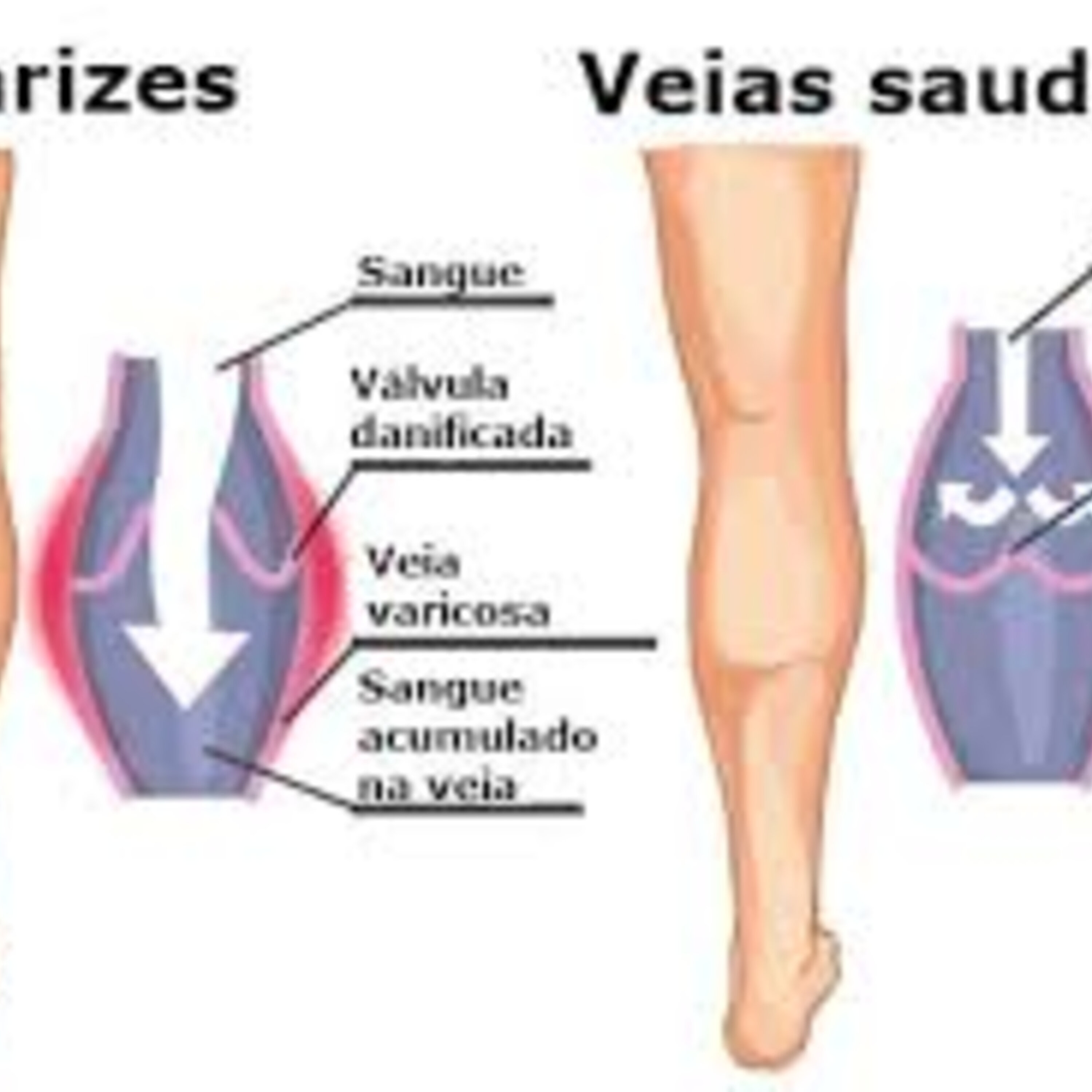 Varizes