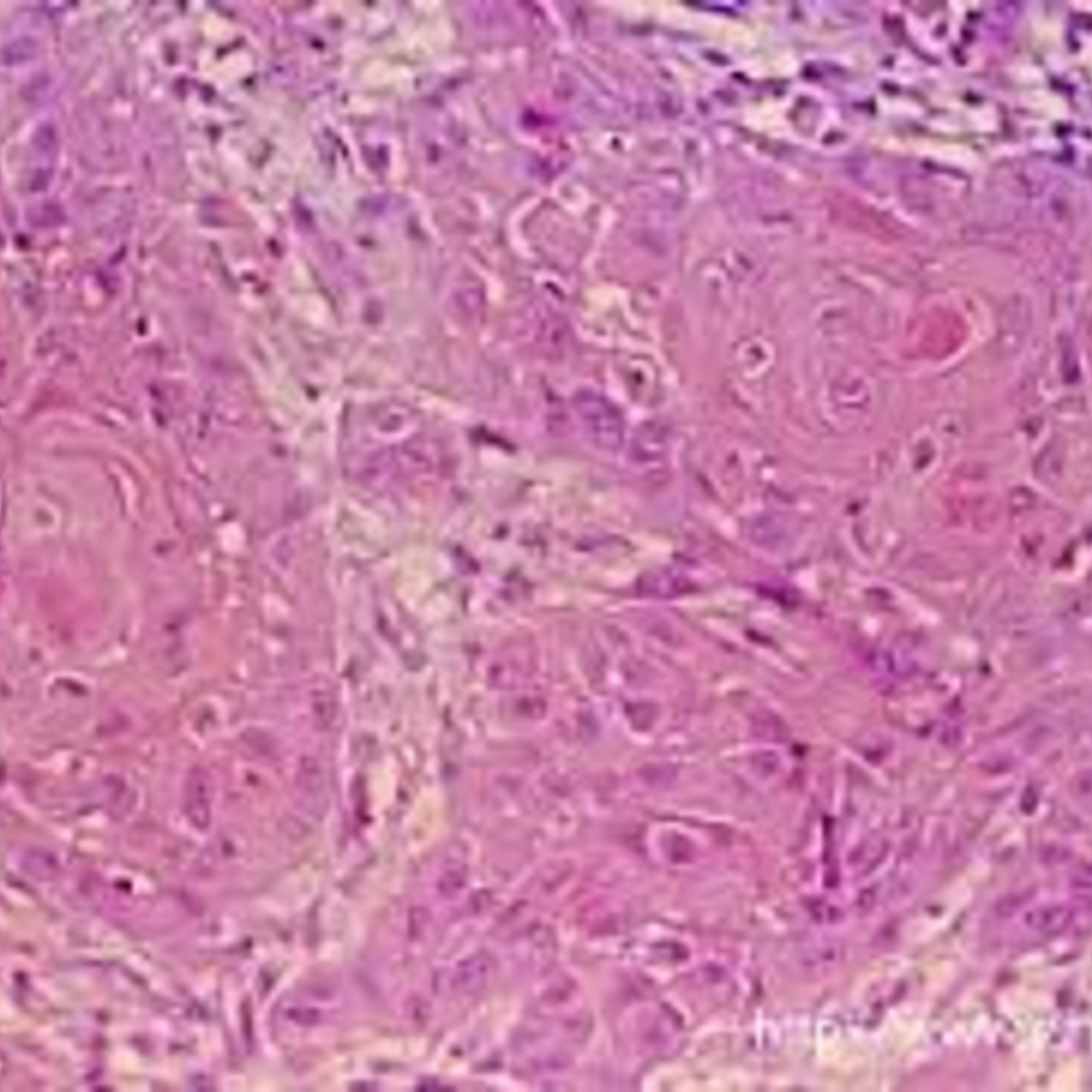 Carcinoma epidermóide