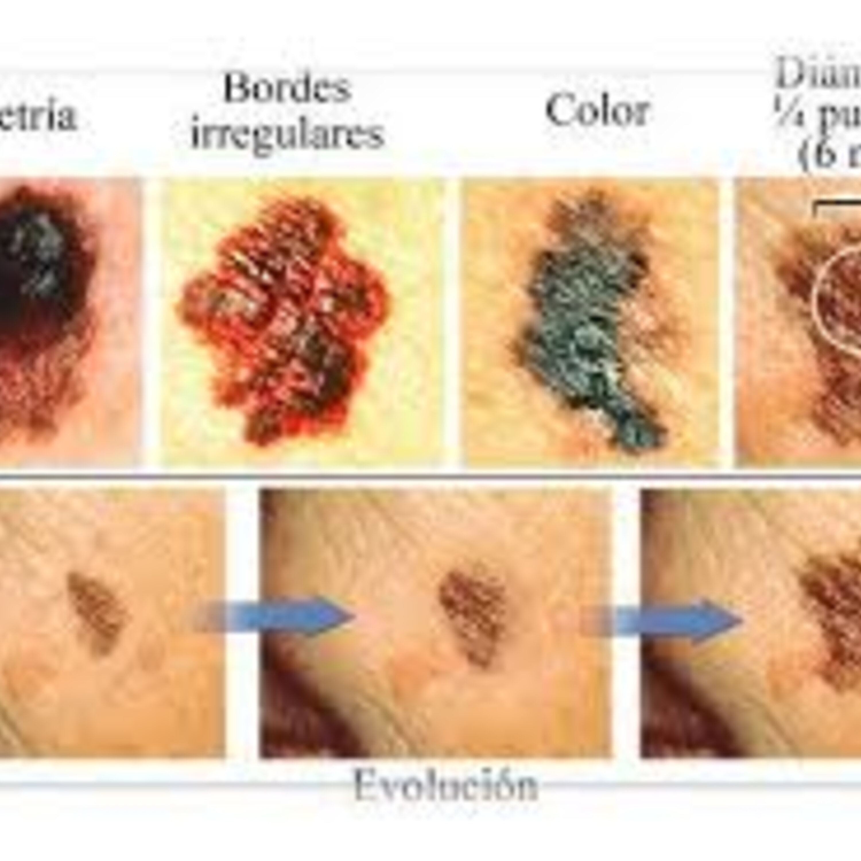 Melanoma