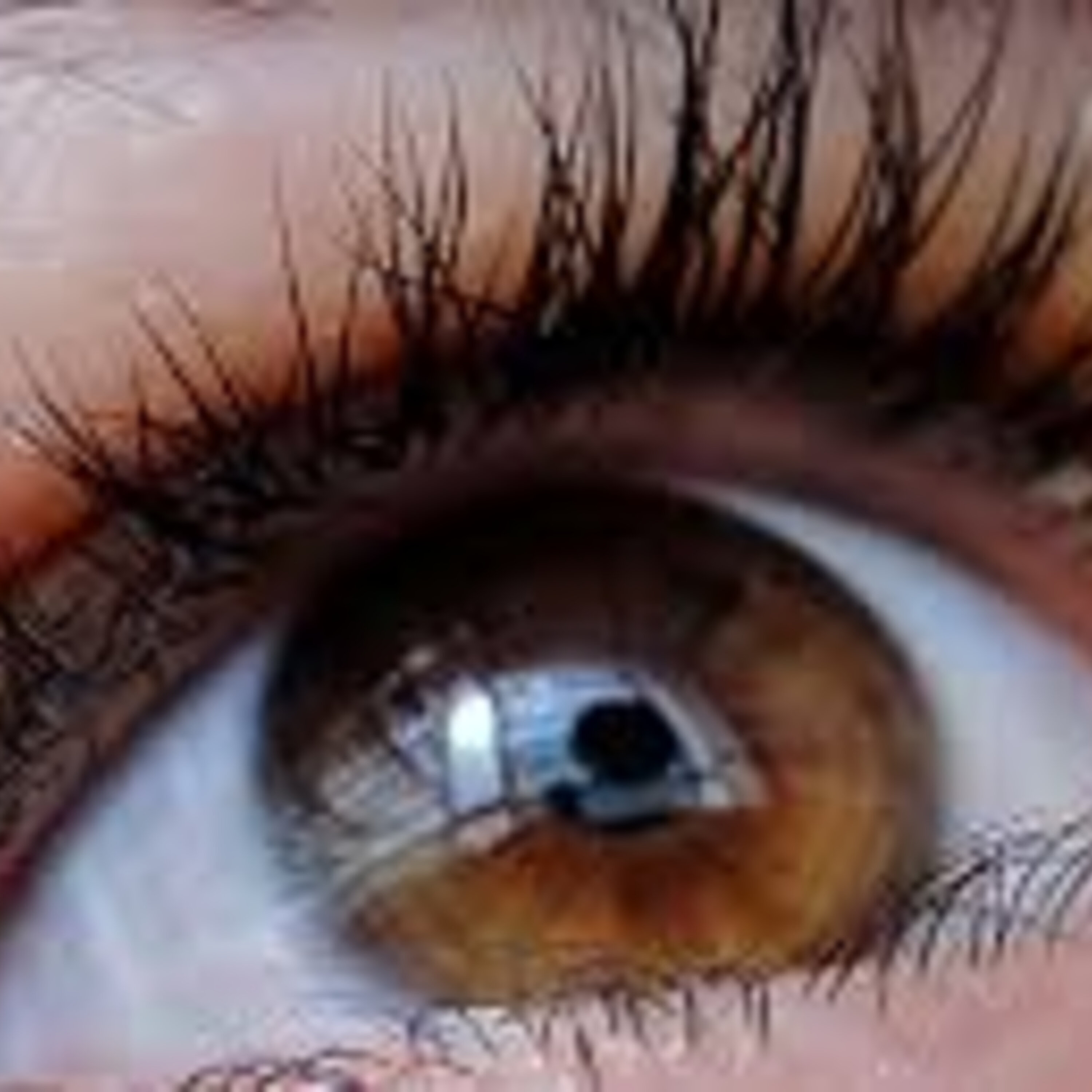 Glaucoma