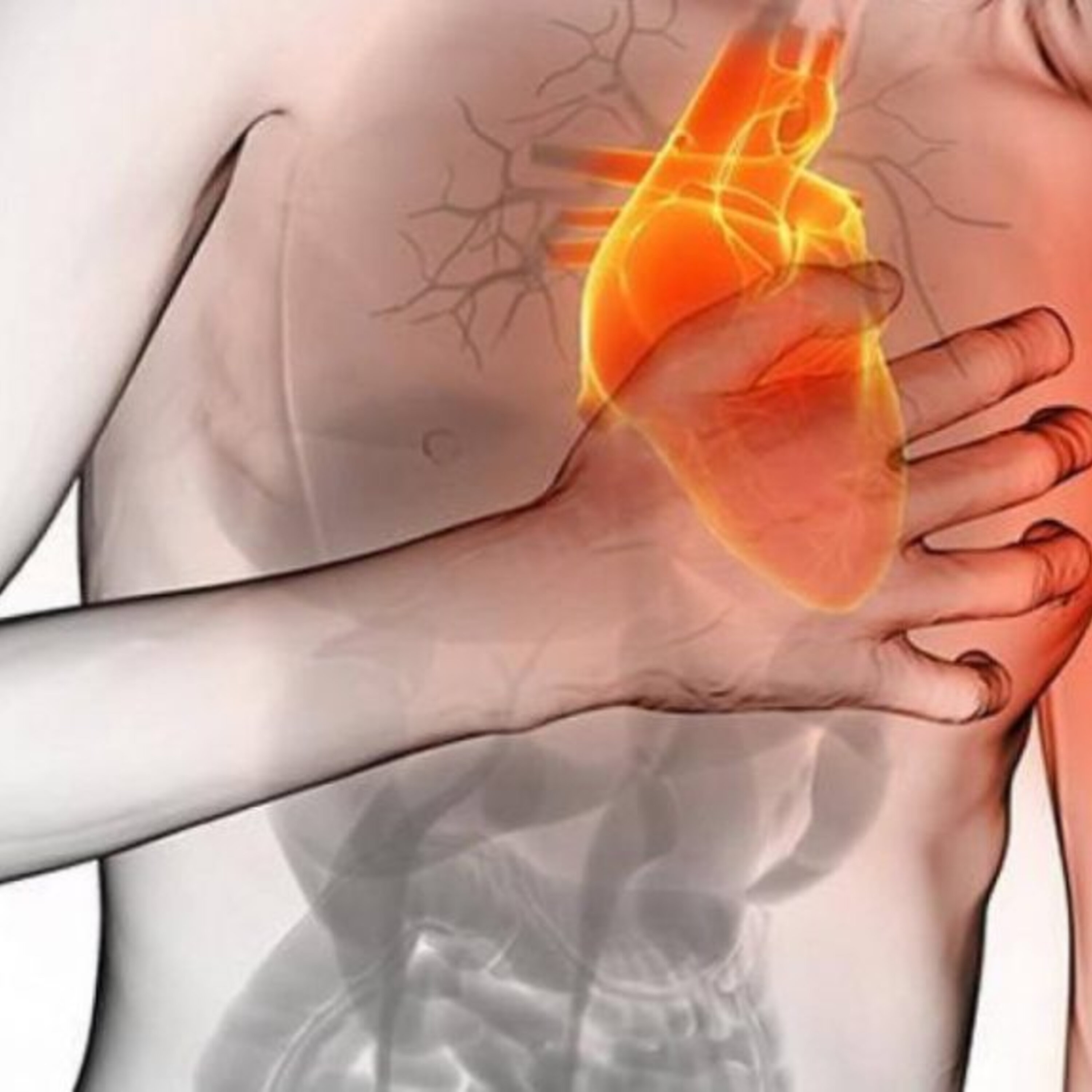 Infarto