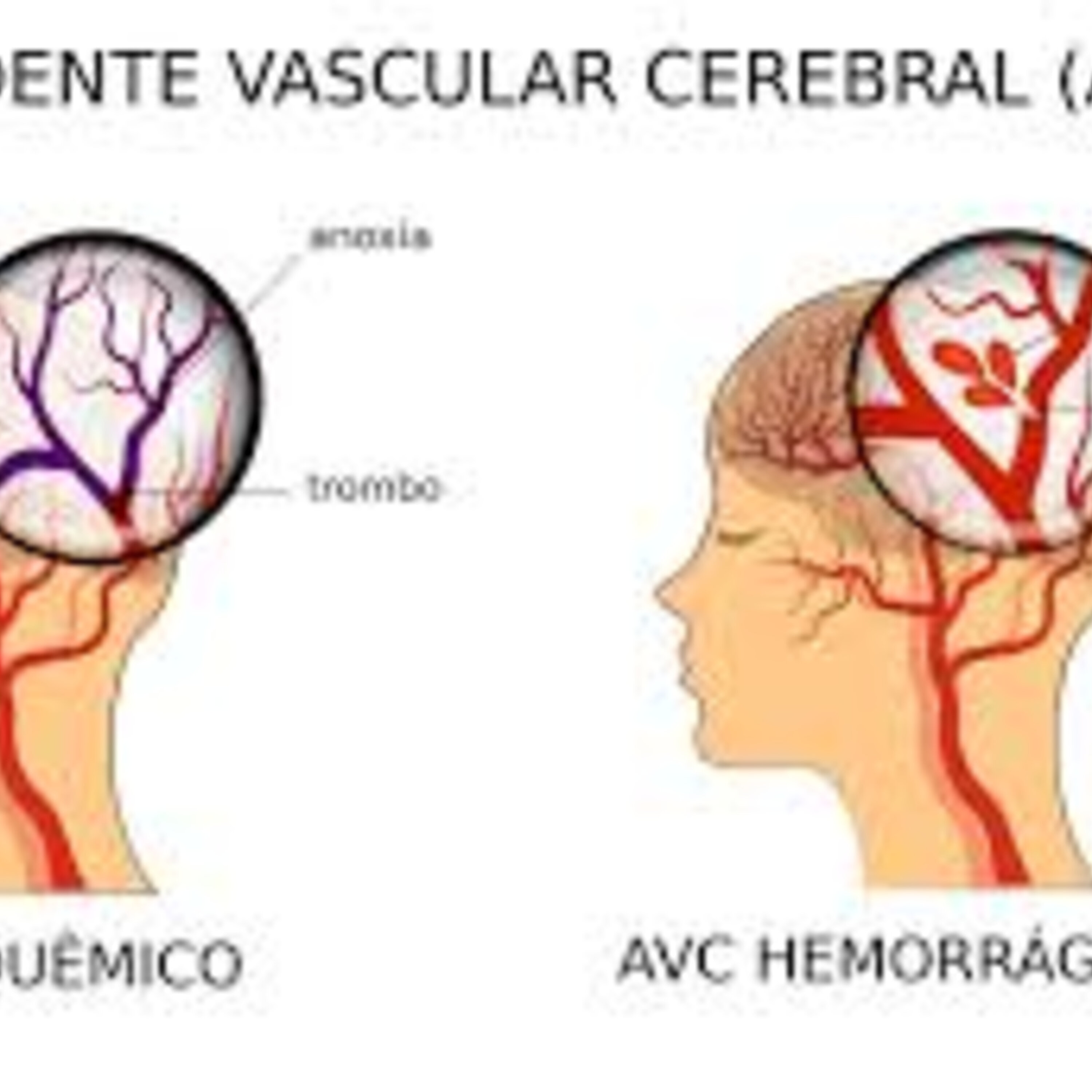 AVC