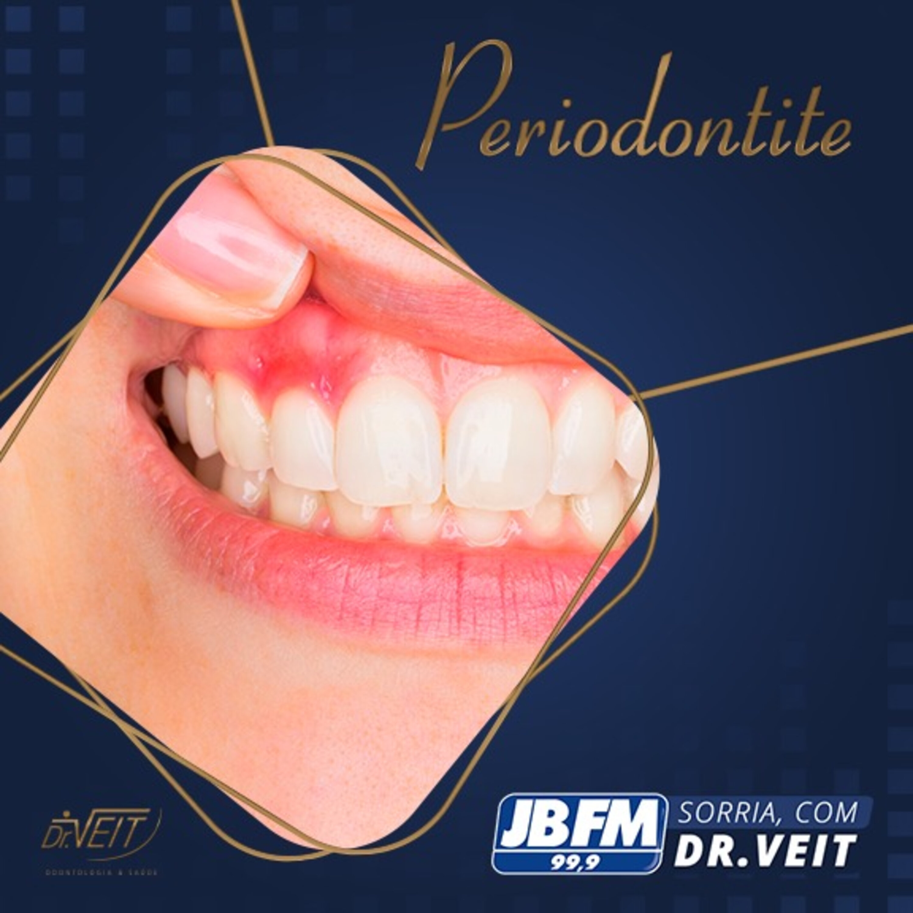 Periodontite