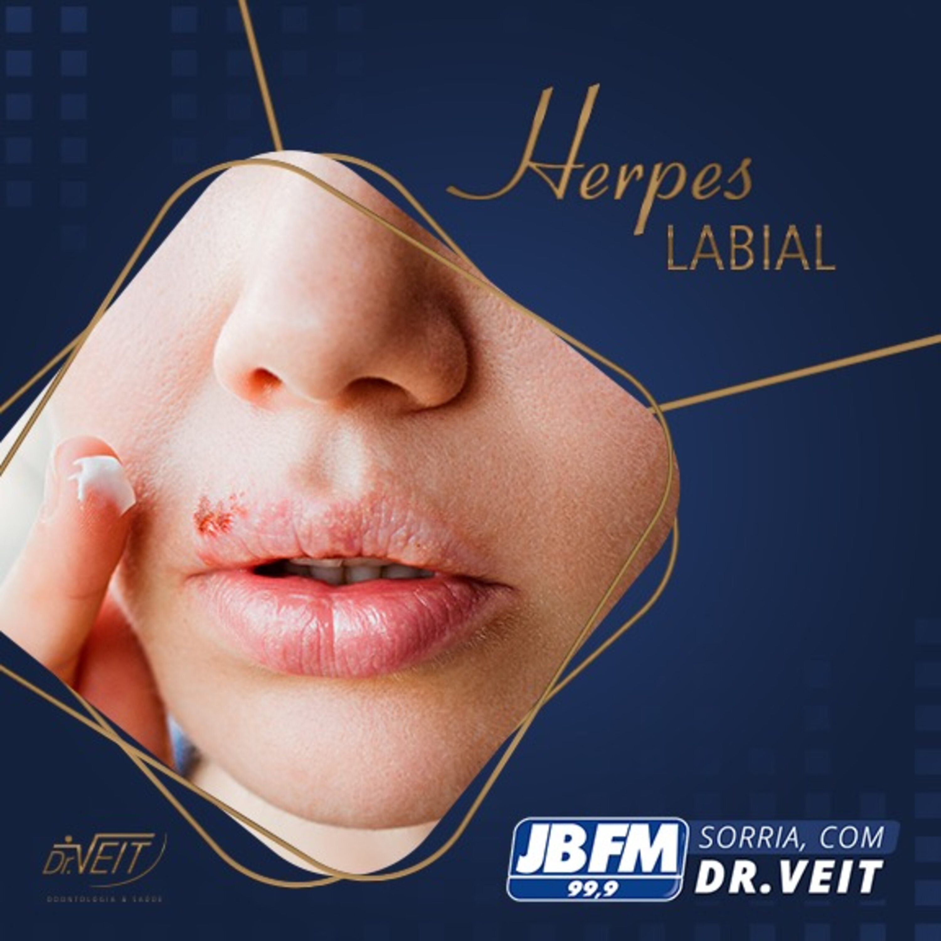 Herpes labial
