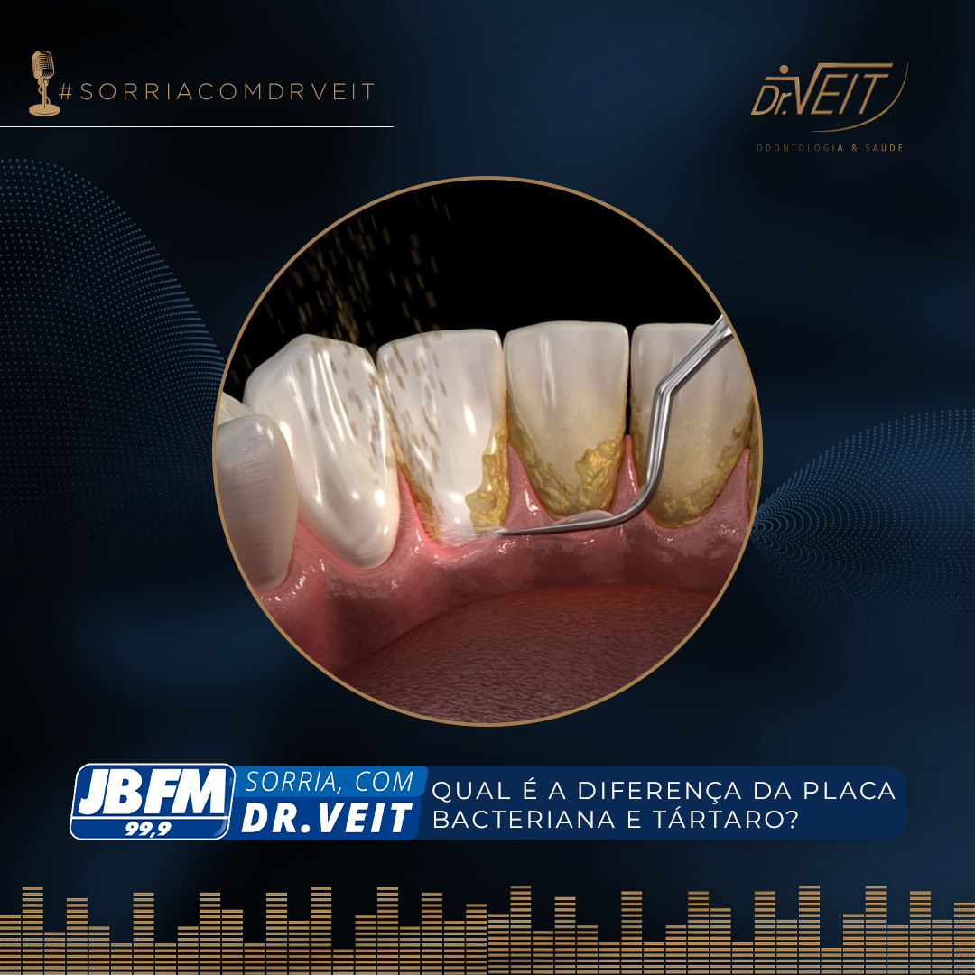 Diferença da placa bacteriana para o tártaro