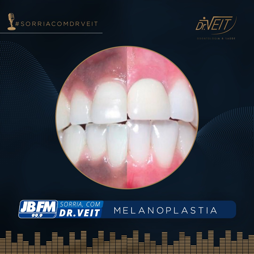 Melanoplastia