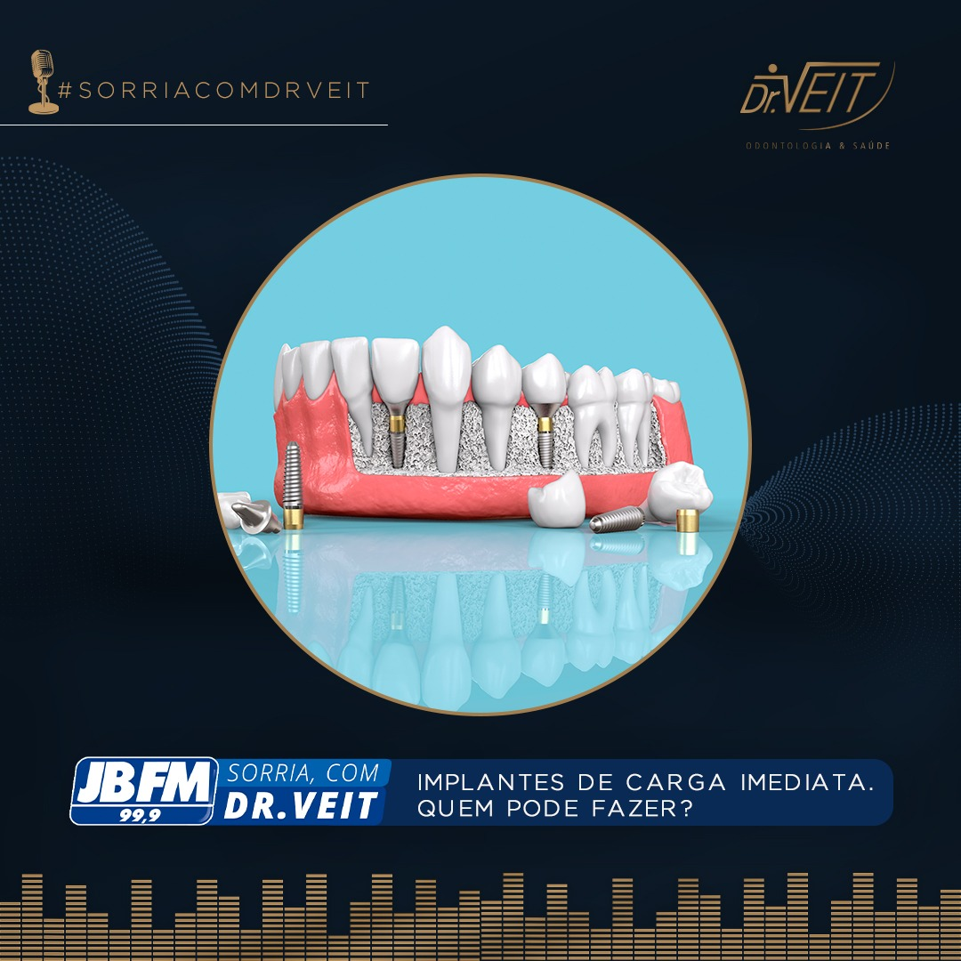 Implantes de Carga Imediata