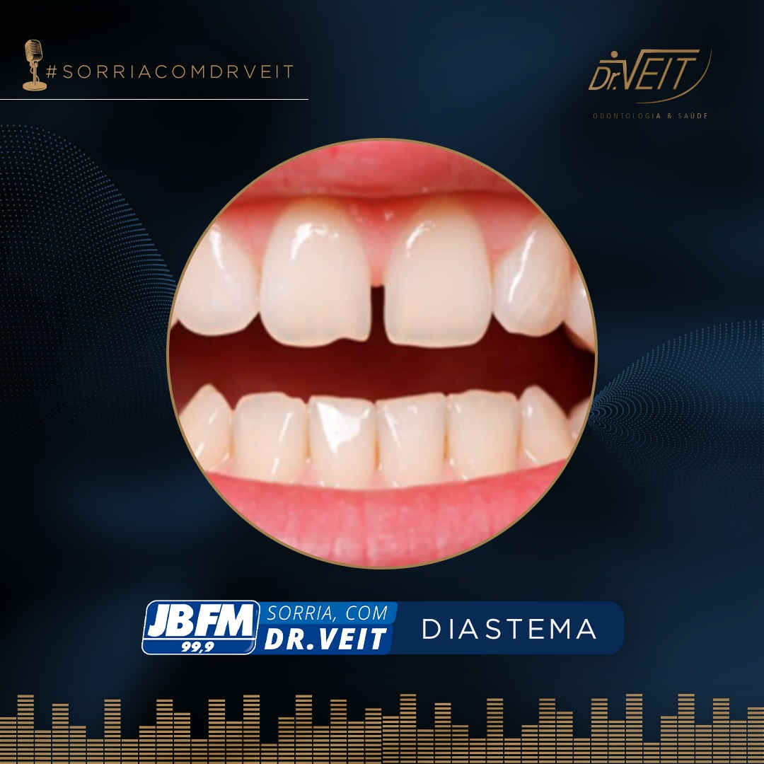 Diastema
