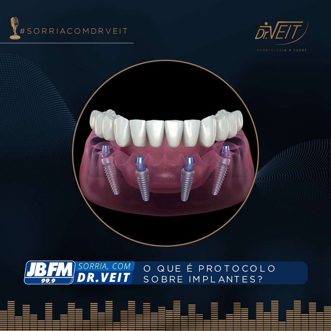 O que é o Protocolo Sobre Implante?