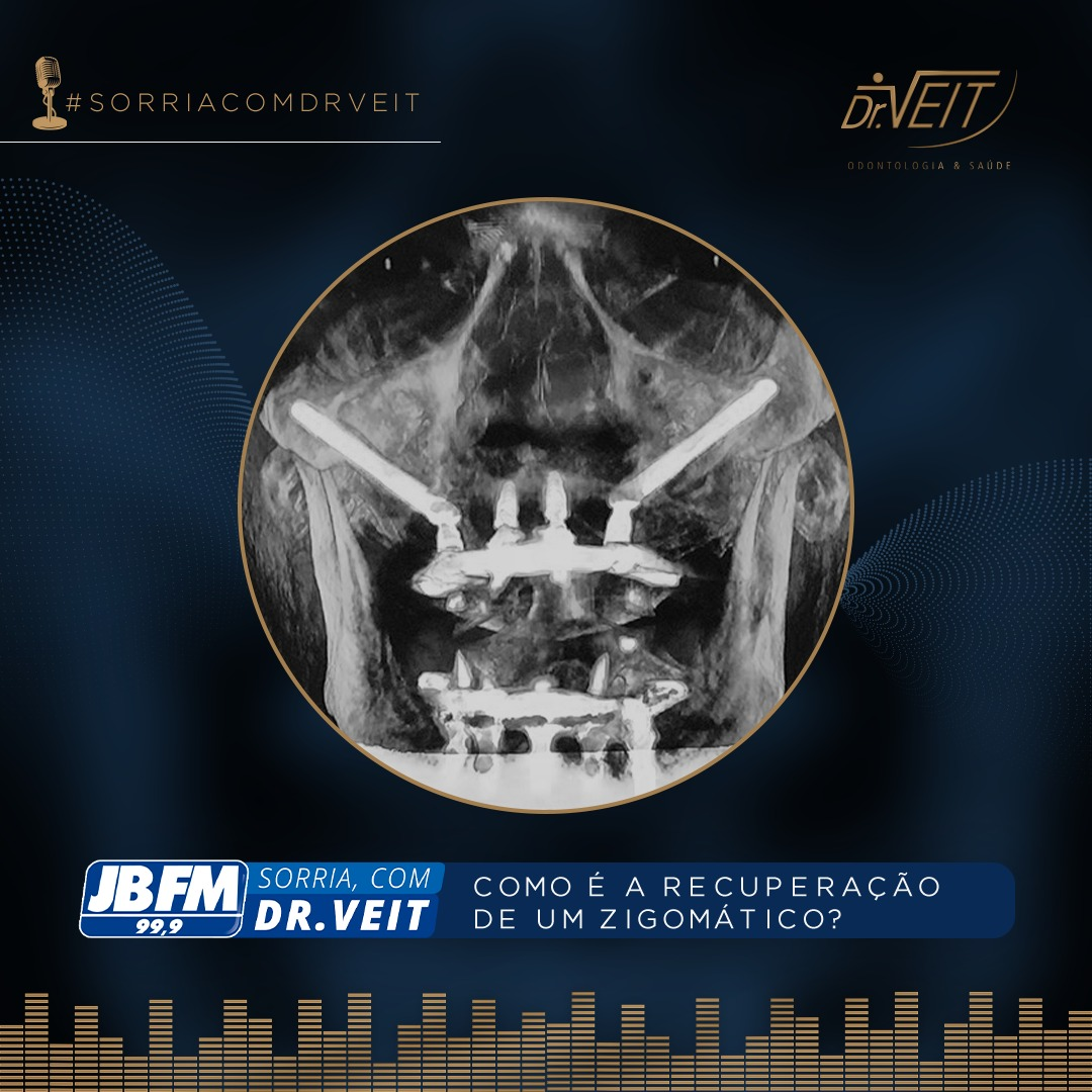 Como é a recuperação de um Implante Zigomático?