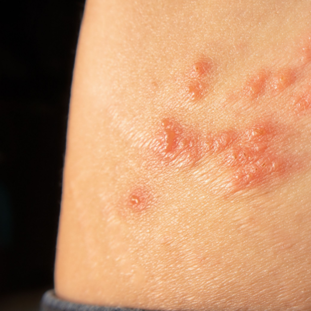 Doctor in the House: What You Should Know About Shingles 