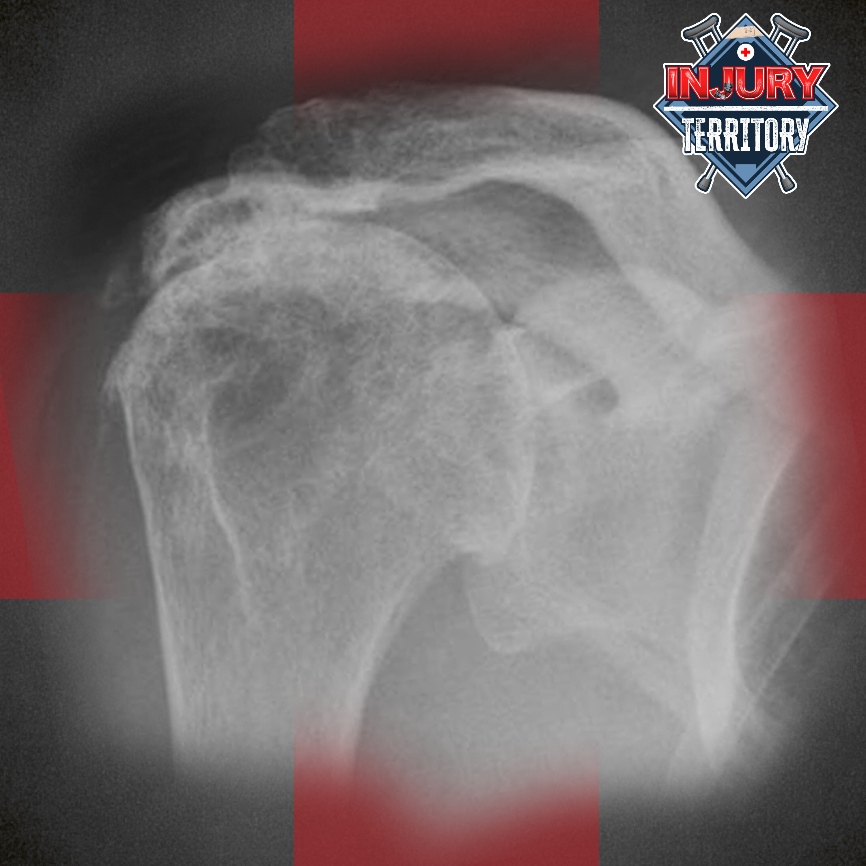 Injury Territory: Rotator Cuff, Pitching Nightmare episode artwork