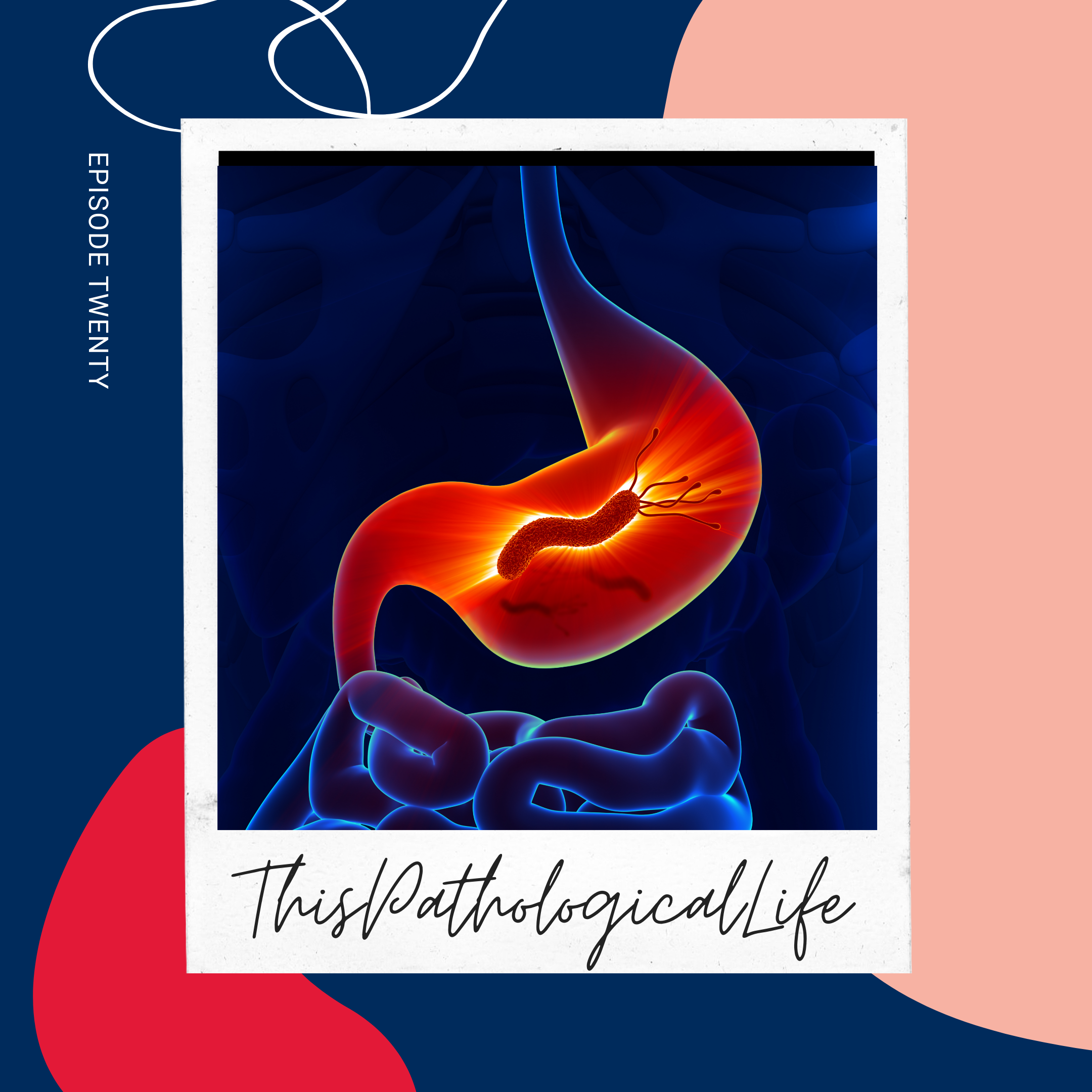 Ep 20 Helicobacter pylori | The No Acid No Ulcer Fallacy