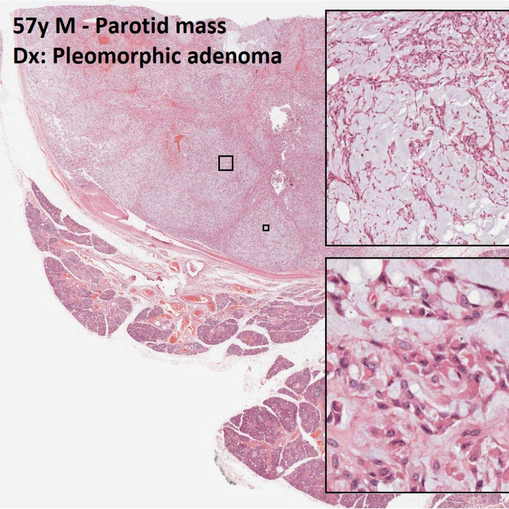 Episode 112: Pleomorphic Adenoma | Mixed Tumours